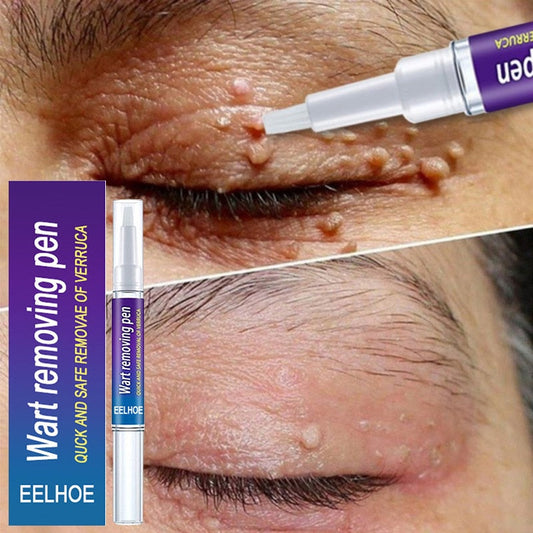 Wart Remover Pen - Fast & Gentle Solution