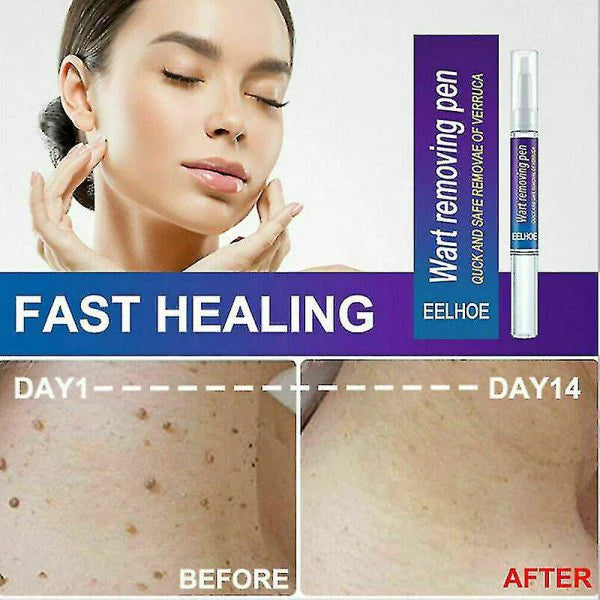 Wart Remover Pen - Fast & Gentle Solution