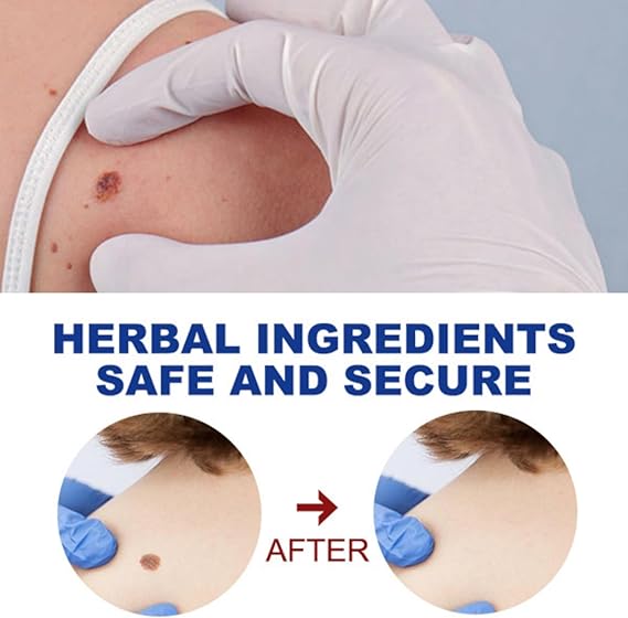 Wart Remover Pen - Fast & Gentle Solution